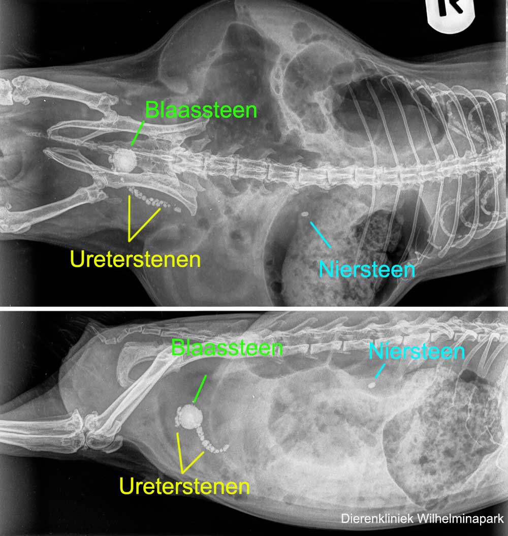 Blaassteen, ureterstenen en niersteen